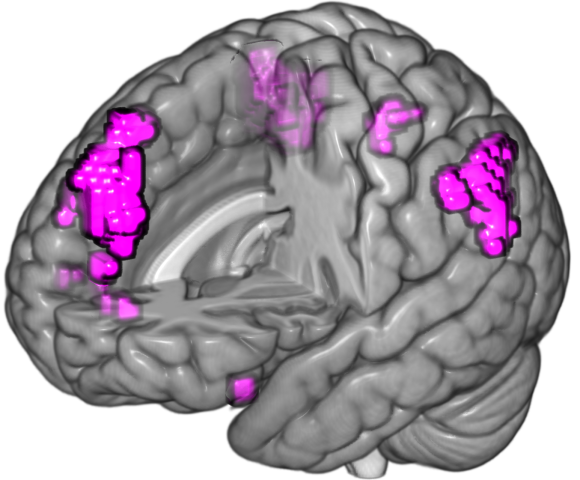 Memory conflict-related brain regions that track deja vu reports